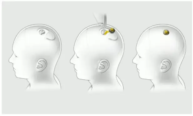 脑机接口技术指南：马斯克宣布Neuralink将在2025年为患者植入设备_脑机接口技术指南：马斯克宣布Neuralink将在2025年为患者植入设备_脑机接口技术指南：马斯克宣布Neuralink将在2025年为患者植入设备